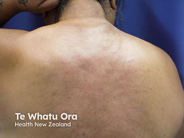 Faint erythema and skin thickening due to scleredema