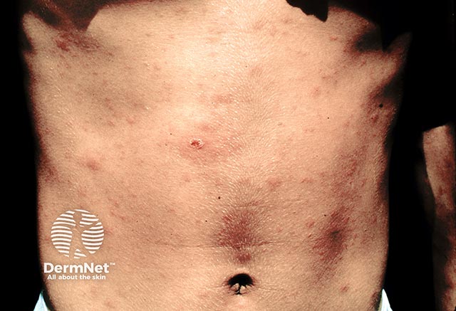 The rash of scrub typhus - the eschar of the mite can be seen on the right upper and left mid abdomen; elsewhere there is a maculopapular eruption