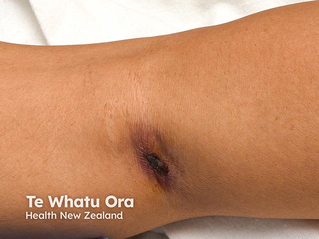 The eschar at the site of the infected mite bite in scrub typhus