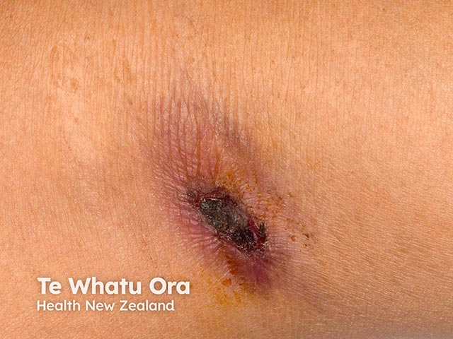 Close up of the eschar of the  infected mite bite in scrub typhus