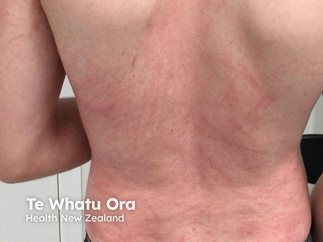 Urticated lesions arising a few hours after swimming in the sea, infested with thimble jellyfish