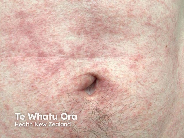 Papules and weals arising after swimming in thimble jellyfish-infested seawater 