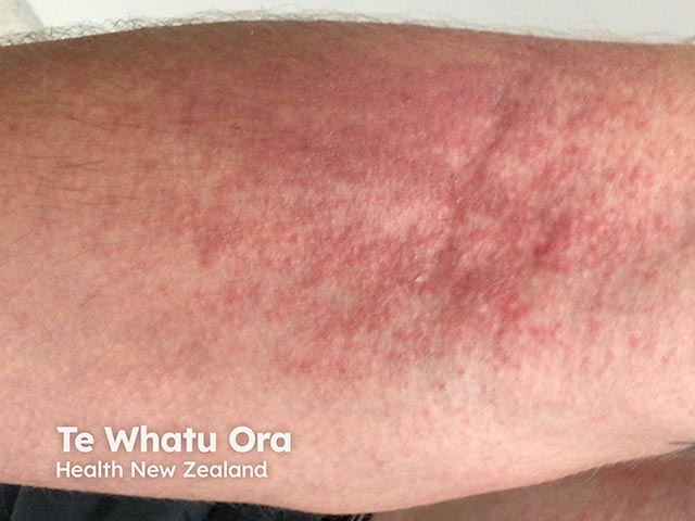 Papules and weals arising in the antecubital fossa after swimming in thimble jellyfish-infested seawater 