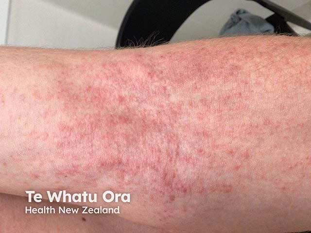 Urticated erythematous papules on the arm due to seabather's eruption