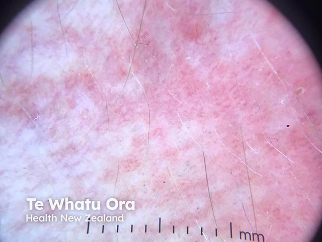 Dermoscopy of seabather's eruption