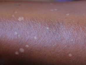 Seborrhoiec dermatitis