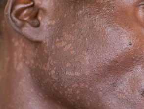 hiv rash on chest black people