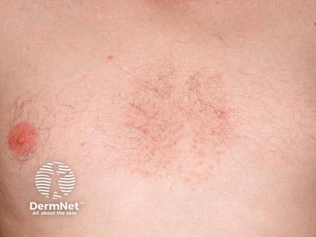 Malassezia folliculitis on the chest