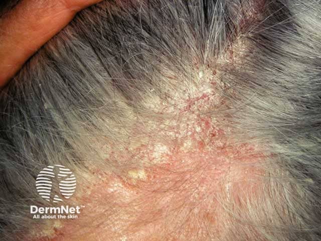 Confluent erythema and scale due to scalp seborrhoeic dermatitis