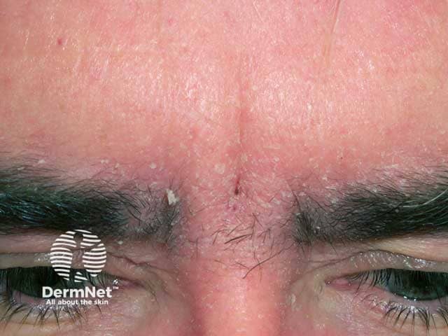 Scale and erythema due to seborrhoeic dermattis on the glabella and brows