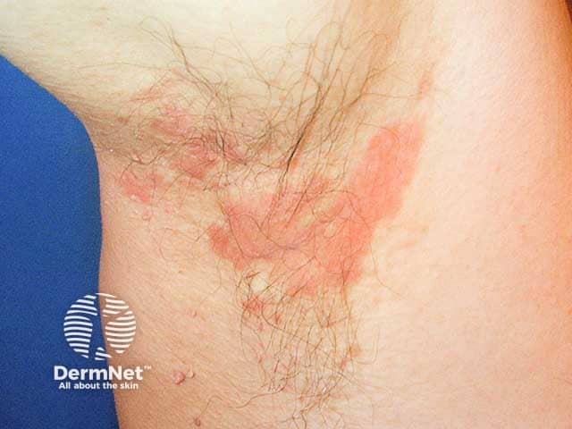 Flexural seborrhoeic dermatitis in the axilla