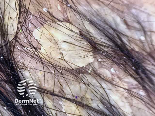 Dermoscopic image of seborrhoeic dermatitis showing adherent yellowish scales and interfollicular oily material on the scalp of a male infant