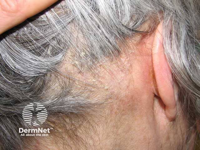 Thick scale of seborrhoeic dermatitis in the scalp