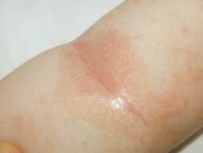 Seborrhoiec dermatitis