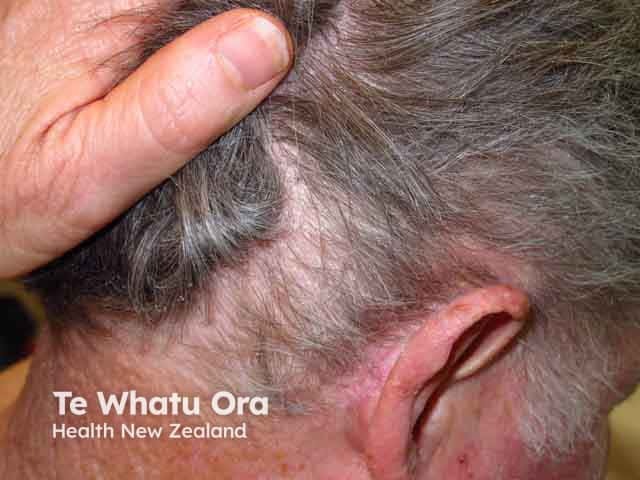 Retroauricular seborrhoeic dermatitis