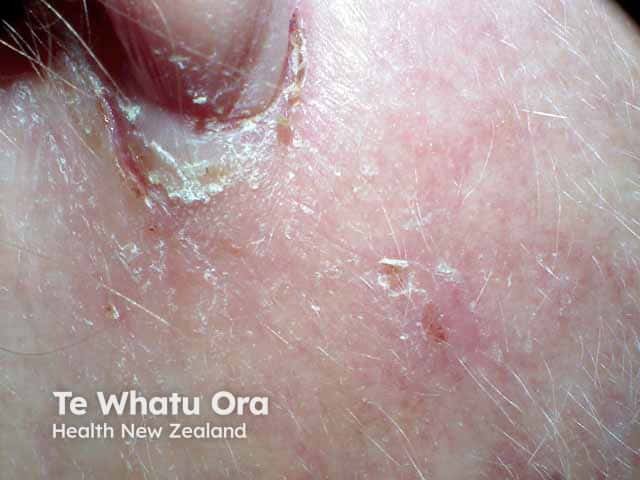 Seborrhoeic dermatitis around the ear lobe