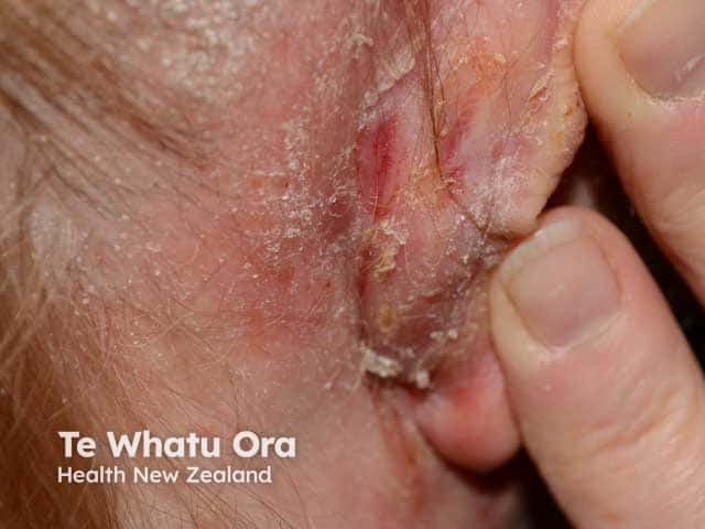 Retroauricular seborrhoeic dermatitis