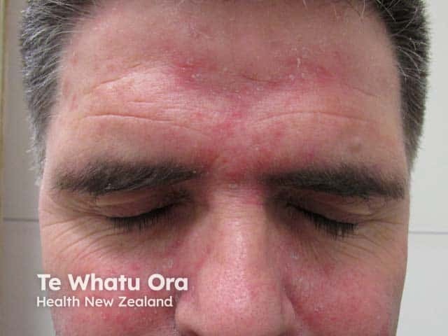 Seborrhoeic dermatitis and co-existing rosacea on the cheeks and forehead