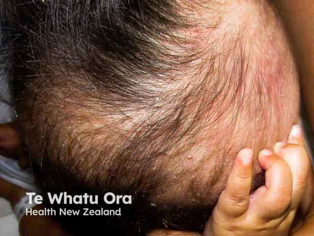 Yellow scale in infantile scalp seborrhoeic dermatitis