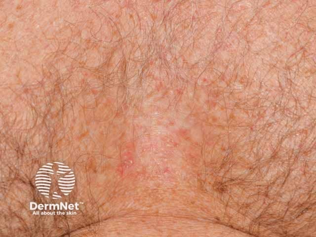 Presternal seborrhoeic dermatitis