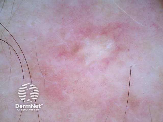 Dermoscopy of presternal seborrhoeic dermatitis