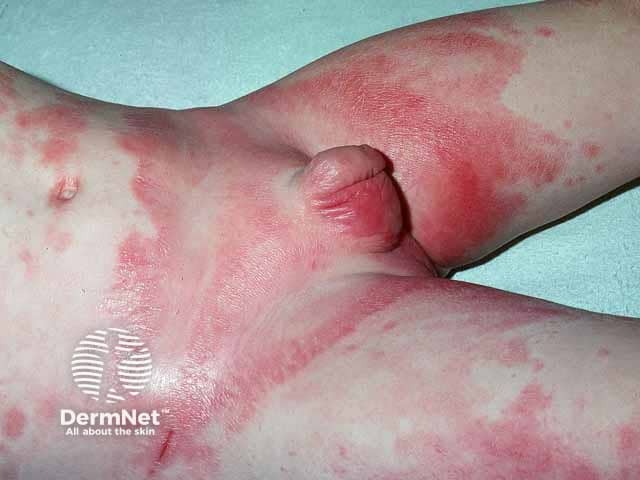 Severe seborrhoeic dermatitis in the napkin area