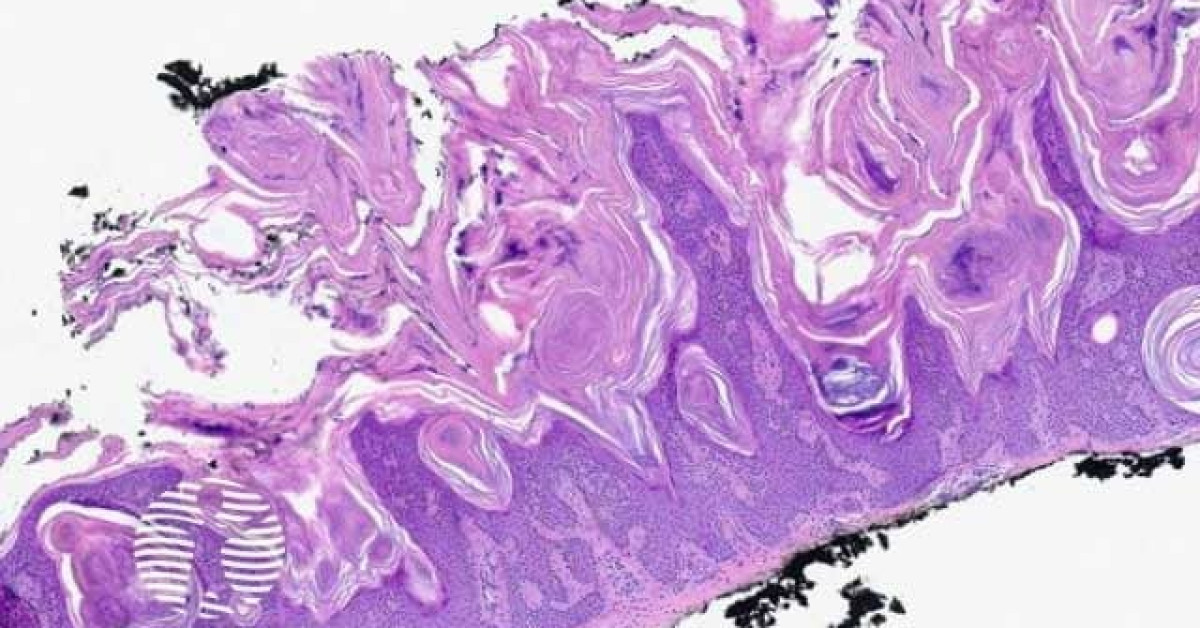 Seborrhoeic keratosis image