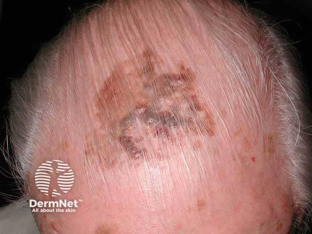A giant scalp seborrhoeic keratosis