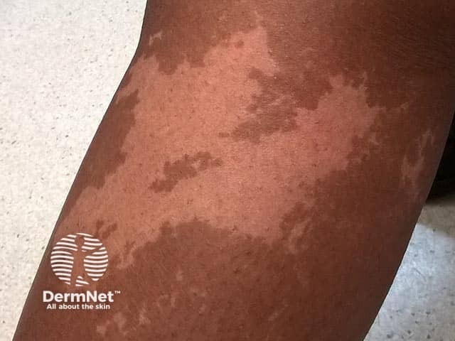 A unilateral depigmented lesion on the arm - the child was otherwise well.  Now termed segmental pigmentation disorder