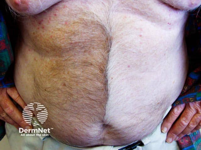Segmental pigmentation disorder producing block-like hyperpigmentation on the right abdomen with a sharp midline cut-off