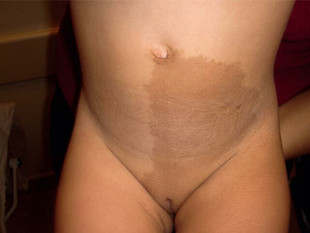 Hyperpigmentation on the lower abdomen with a sharp cut-off at the midline