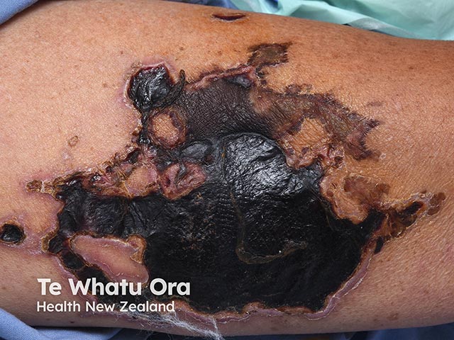 Necrosis on the leg due to septicaemia