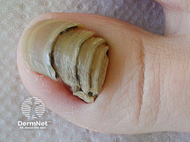Shrimp nail affecting the great toe - sequential onychomadesis resembling a crustacean