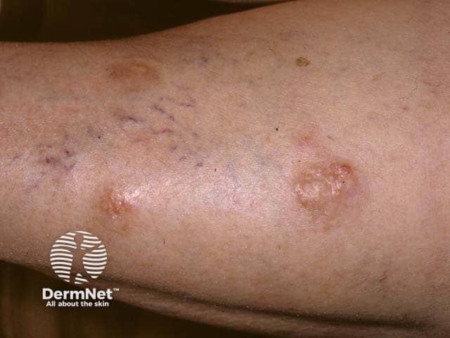 Sjögren syndrome: nodular amyloid