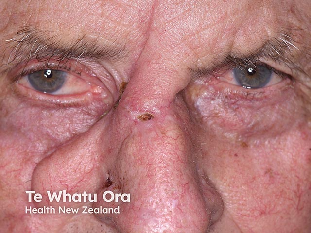 A transposition flap repair of a nasal skin cancer