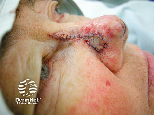 A flap has been fashioned to cover the defect after skin cancer removal