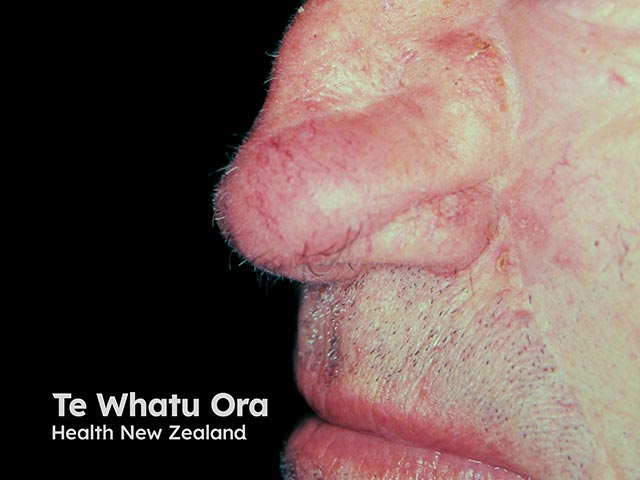The late result of a flap repair after excision of a large basal cell carcinoma on the nose