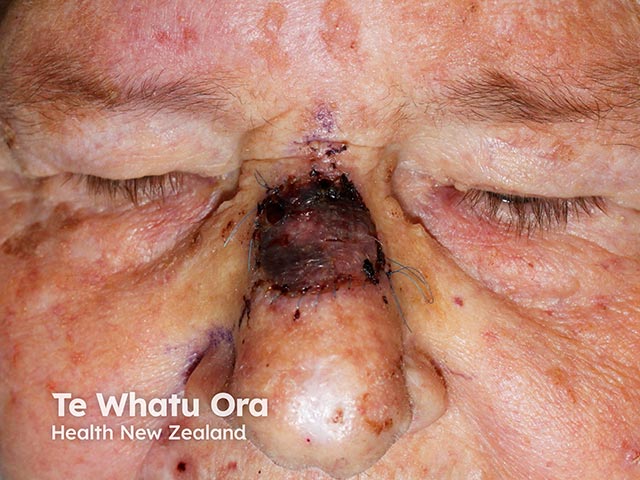 A flap repair result after basal call carcinoma excision