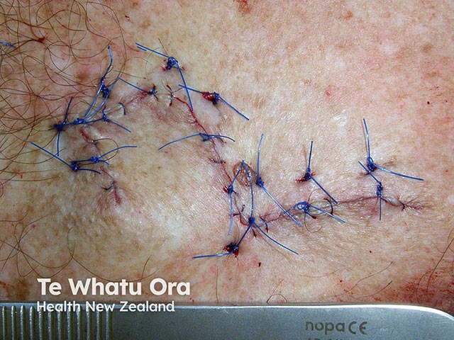 The immediate post-operative image of the flap repair