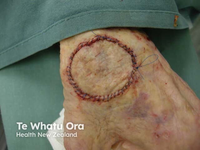 A full-thickness skin graft on the wrist immediately after skin cancer excision