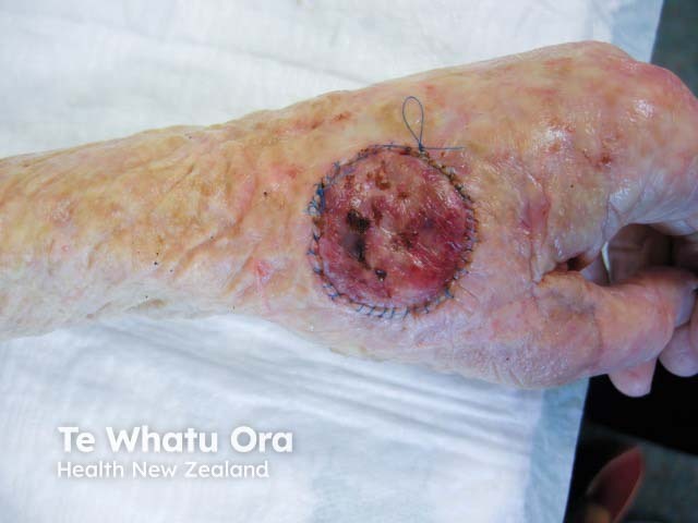 Appearances of skin graft 6 days post-operatively