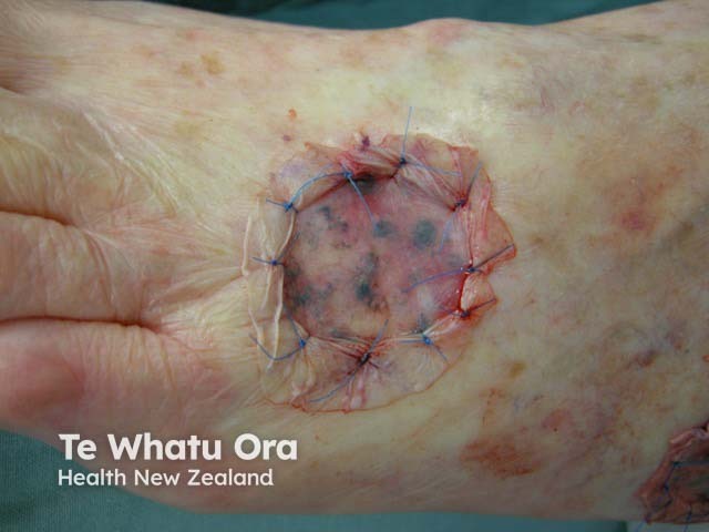 Partial-thickness skin graft after skin cancer excision