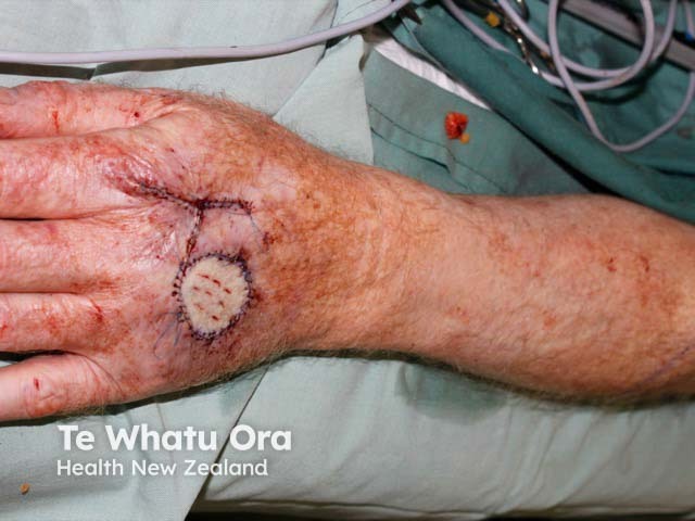 A full-thickness graft on the hand - it has been fenestrated to allow blood and exudate to come out from under the graft