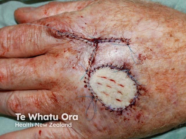 A full-thickness graft on the hand - it has been fenestrated to allow blood and exudate to come out from under the graft