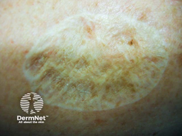 A healed skin graft after melanoma excision