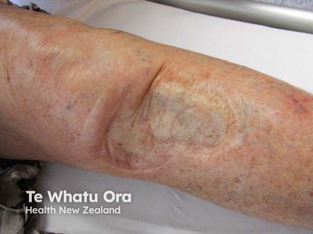 A healed skin graft after skin cancer excision on the knee