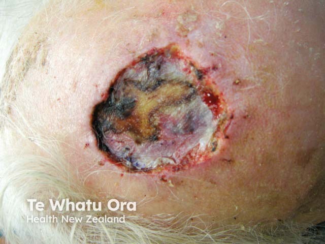 A split-thickness graft on the scalp after excision of a squamous cell carcinoma