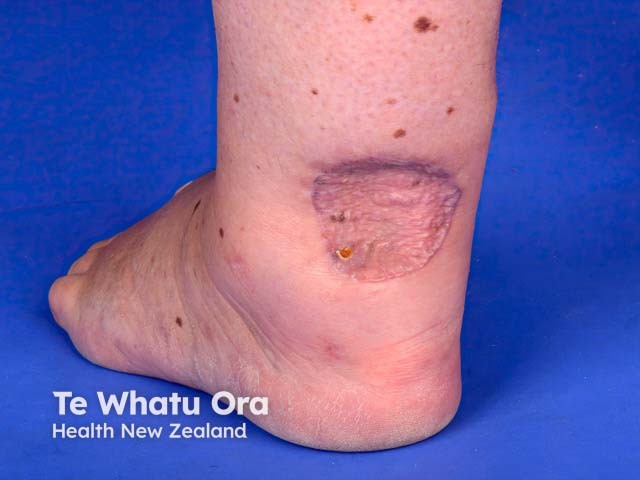 A healed skin graft after excision of melanoma on the ankle