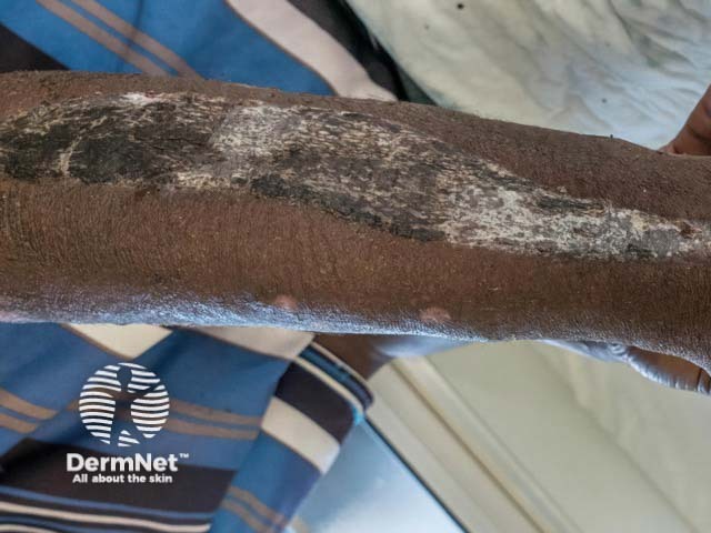 A skin graft several years after trauma to the leg in skin of colour