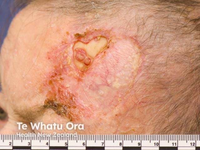 An ulcerated area at the margin of a skin graft site after skin cancer excision